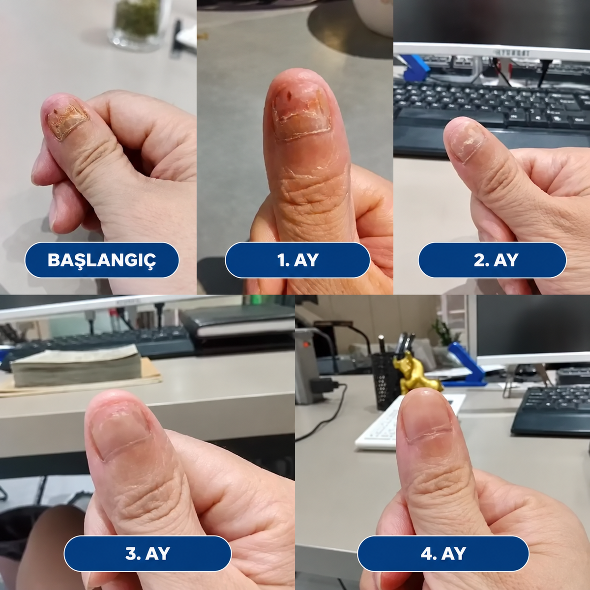 Nailofix® Mantarlı Tırnak Bakım Bandı